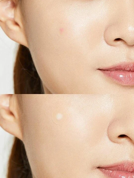 COSRX  Acne Pimple Master Patch 1pcs